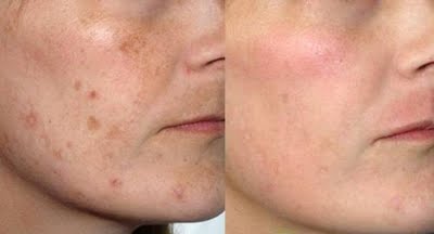 eliminar manchas en la cara