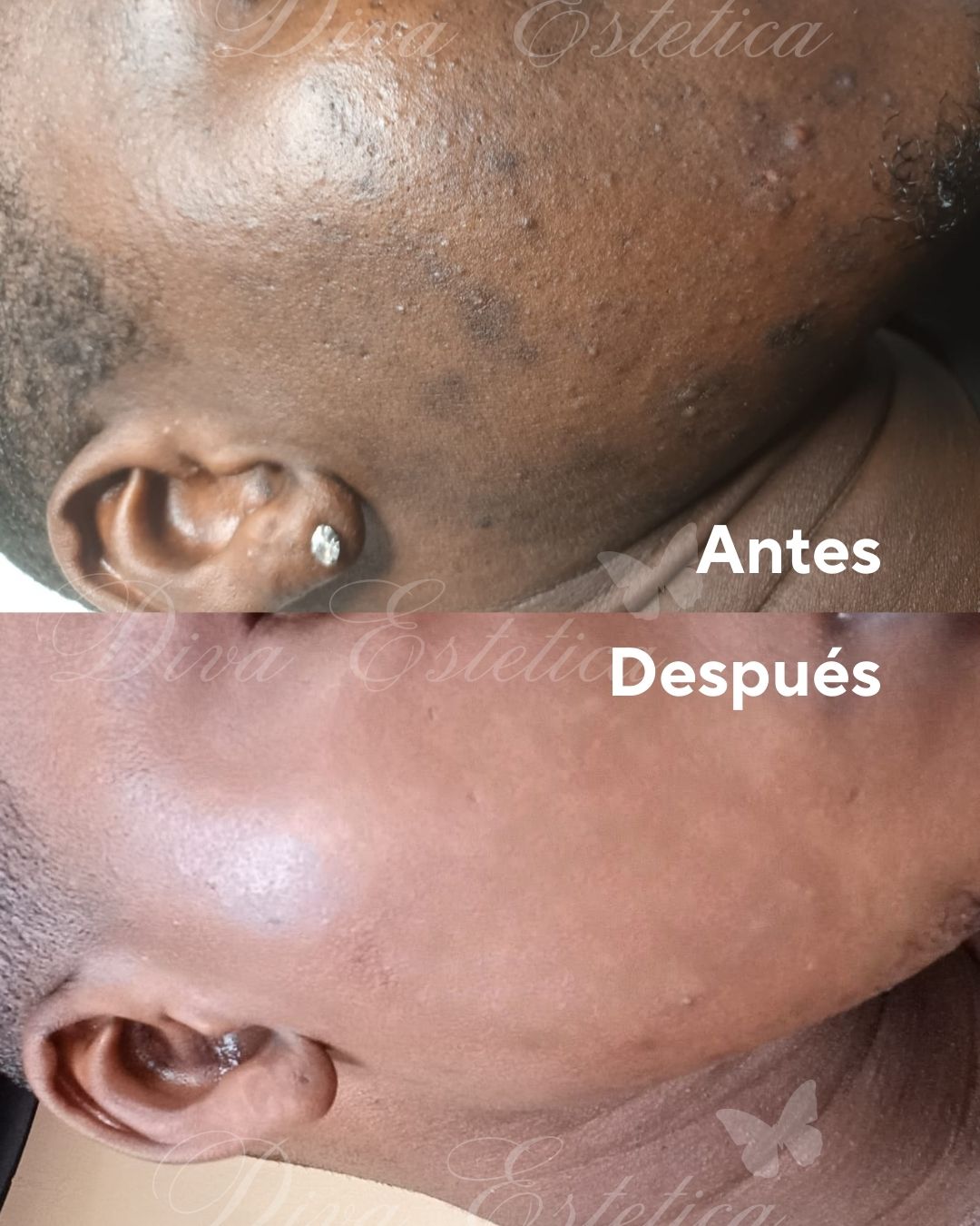 Despigmentación + fórmula magistral