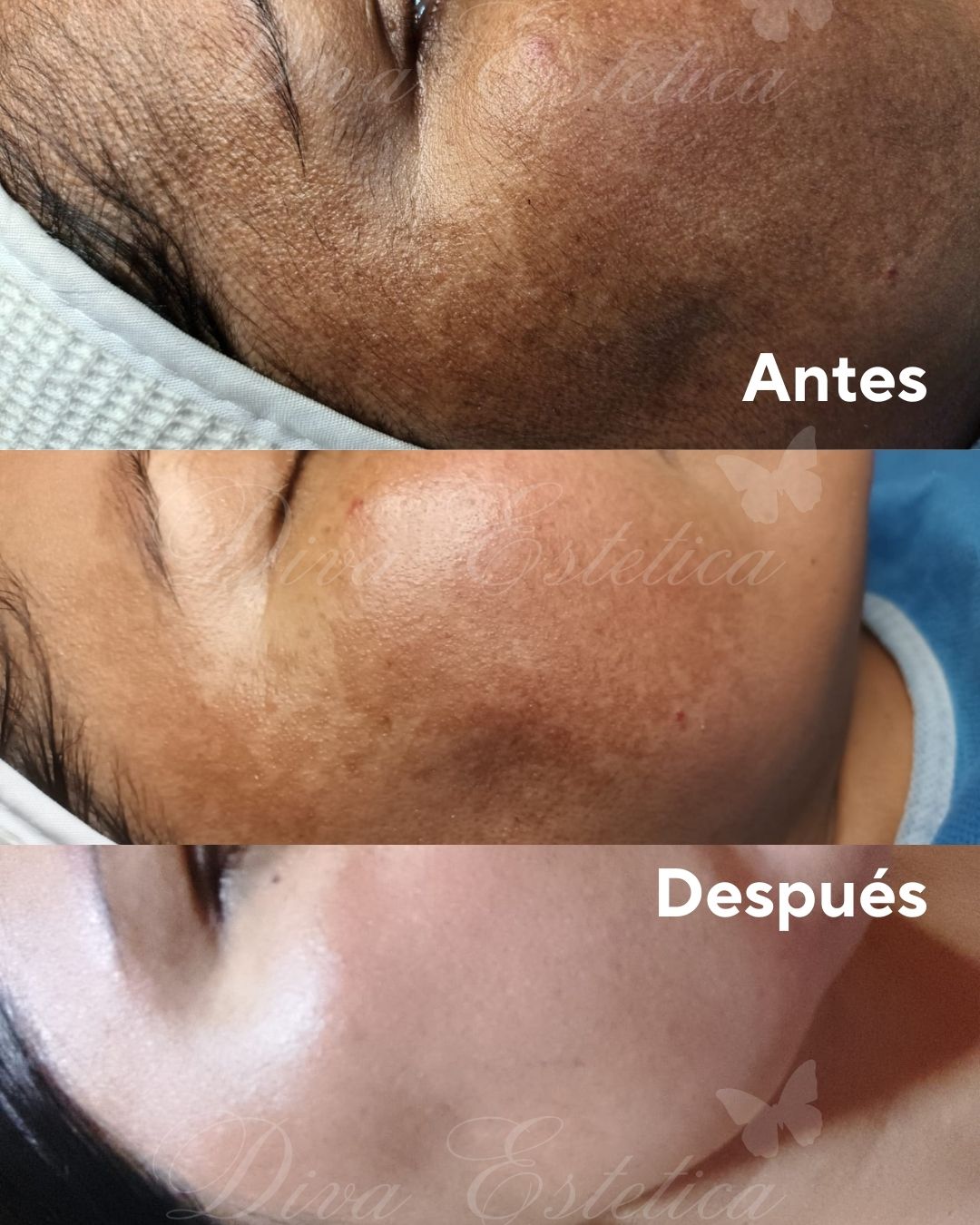 Despigmentación química