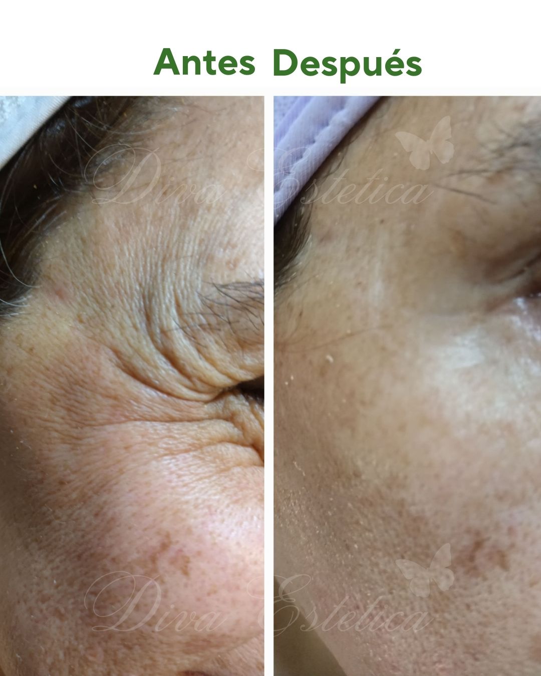 Plasma Rico en Plaquetas