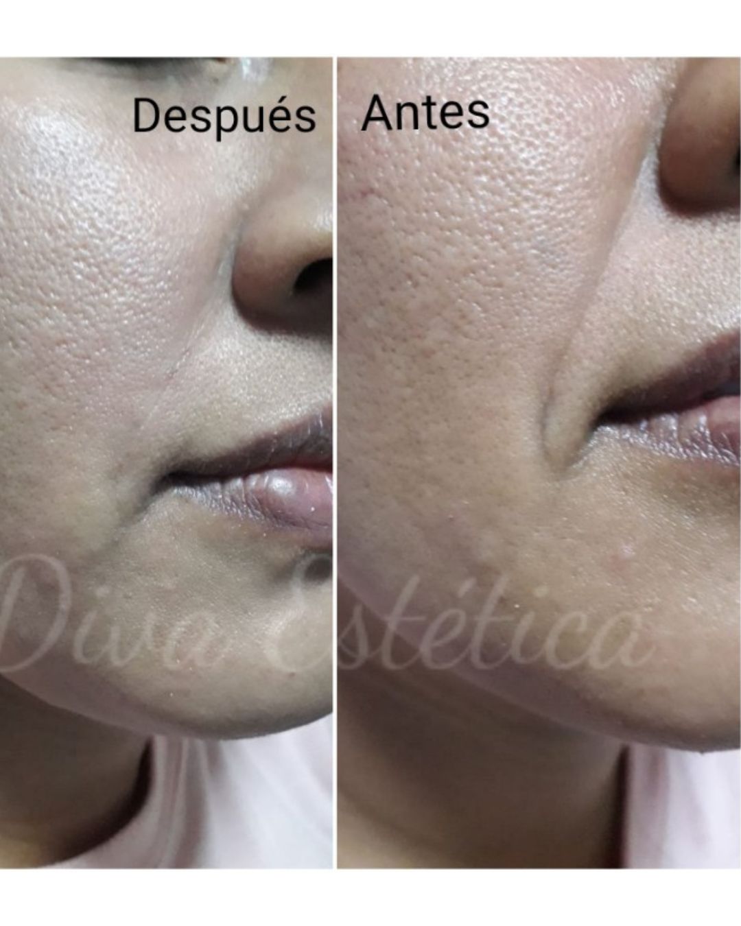 Plasma rico en PLaquetas