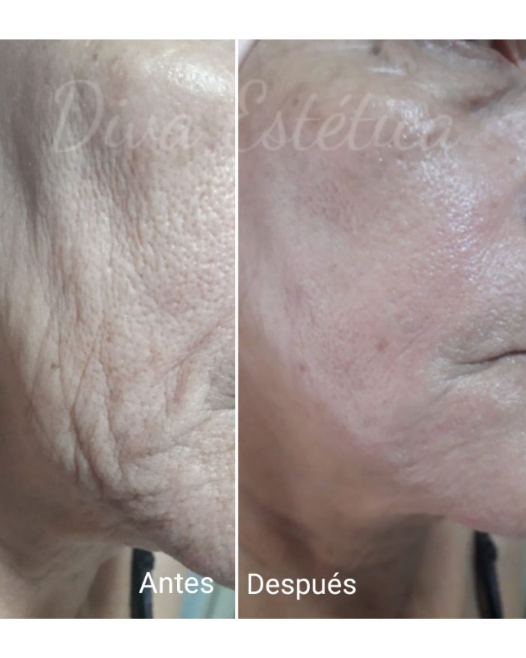 Bioestimuladores de colágeno